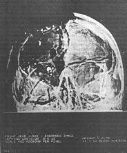 Enhanced anterior-posterior X-ray from Kennedy autopsy
