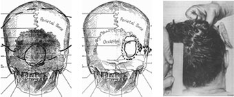 Left: HSCA drawing by mortician Tom Robinson. Middle: HSCA drawing by FBI agent James Sibert. Right: HSCA recreation of JFK autopsy photo. (no autopsy photo shows rear head wound described by Dallas doctors and autopsy participants)