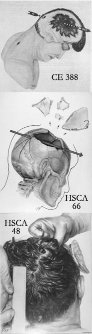 Composite view of: CE 388, the Warren Commission's drawing, HSCA Exhibit 66, the House Committee's depiction, HSCA Exhibit 48, artist's rendering of autopsy photo.