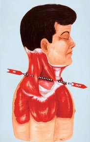 Commission Exhibit 385, one of three representative drawings submitted by the autopsy doctors in lieu of photographs. Drawing by Harold Rydberg.